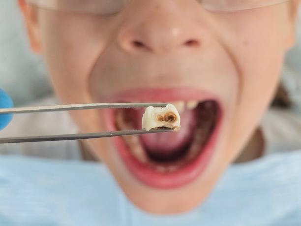 Best Emergency Dental Extractions in Lewistown, PA