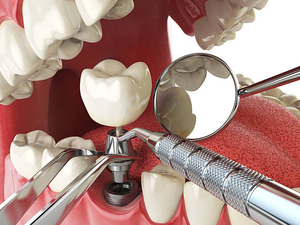 Best Emergency Root Canal Treatment in Lewistown, PA